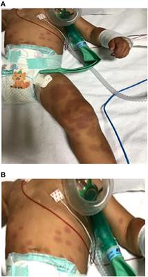 Case Report: Kawasaki Shock Syndrome With Polycyclic Eruption: A Peculiar Brain Imaging